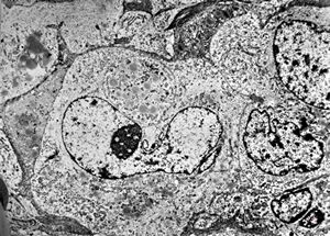 M,64y. | liposarcoma v.s.